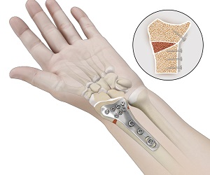 Osteotomy for Distal Radius Malunion