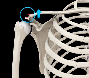 AC Joint Dislocation/Acromioclavicular Joint