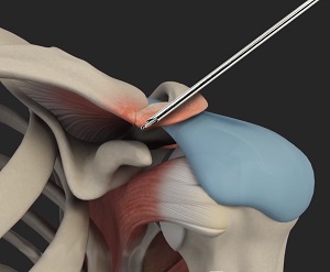 AC Joint Stabilization