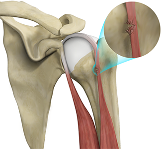 Biceps Tendon Repair