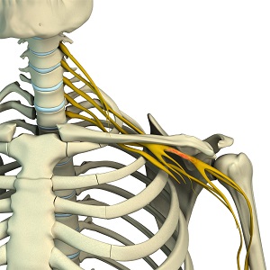 Brachial Plexus Injury