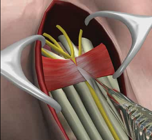 Open Carpal Tunnel Release Surgery