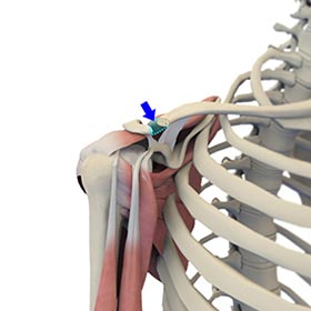 Distal Clavicle Excision