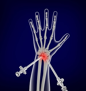 Distal Radioulnar Joint Arthroscopy