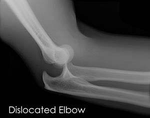 Elbow Instability
