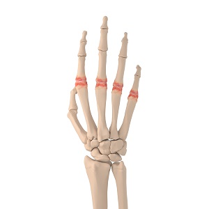 Metacarpophalangeal Joint Arthritis