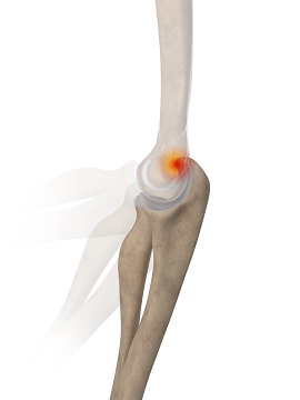 Posterior Impingement of the Elbow