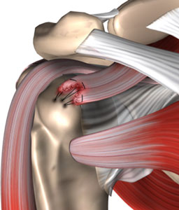 Rotator Cuff repair