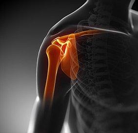 Shoulder Bursitis