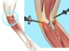 Acromioclavicular Arthritis