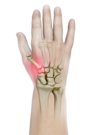 Trapeziometacarpal (TMC) Arthritis