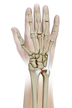 Triangular Fibrocartilage Complex Injury (TFCC)