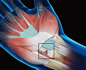 Wrist Ligament Tear & Instability