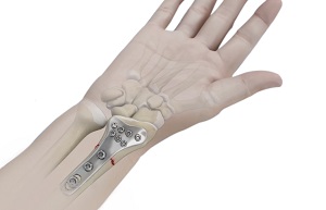 Wrist Open Reduction & Internal Fixation