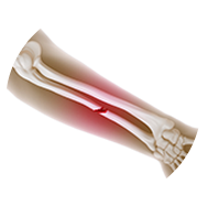 Upper Extremity Fractures